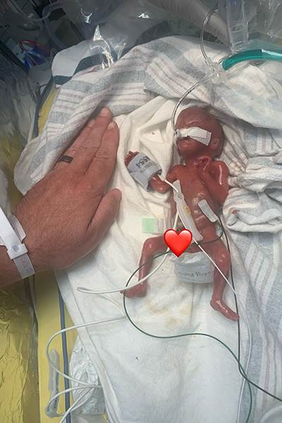 Najranije rođena beba na svijetu - 283 grama u 21. tjednu trudnoće