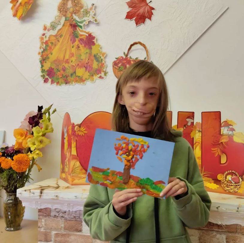  Kako danas izgleda djevojcica rodena bez pola lica?