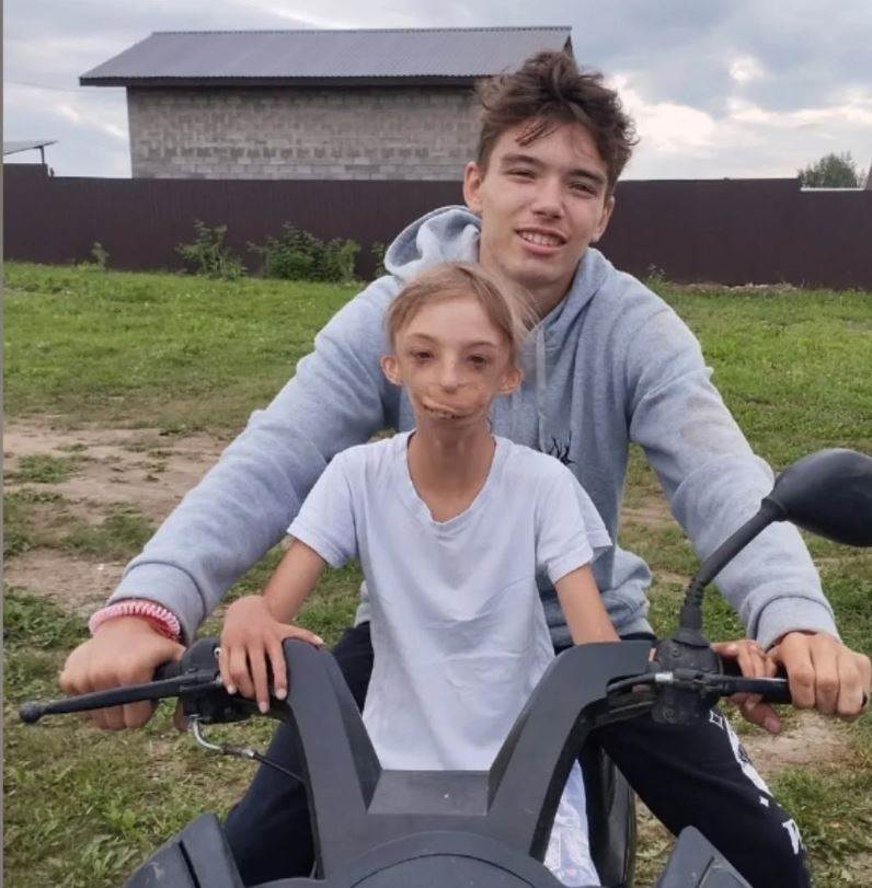  Kako danas izgleda djevojcica rodena bez pola lica?