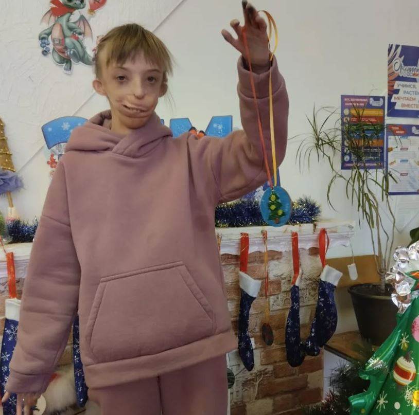  Kako danas izgleda djevojcica rodena bez pola lica?