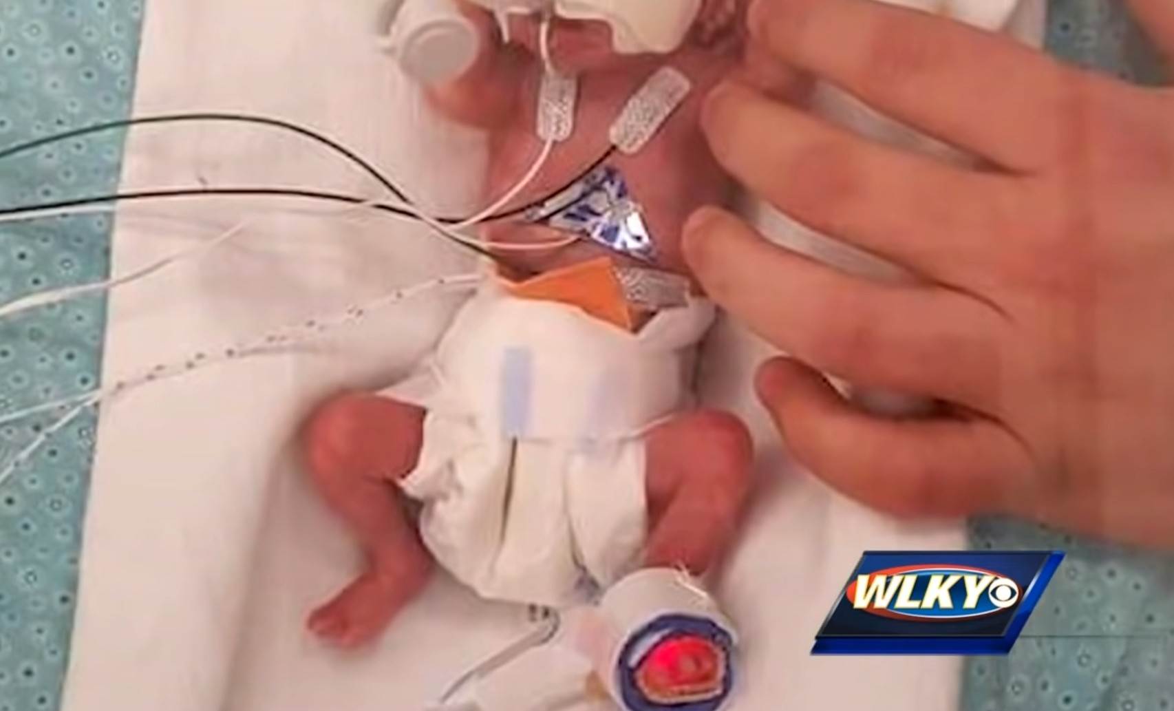 Patuljasti rast kod beba