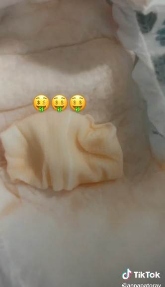 Medicinska sestra pokazala kako uzeti uzorak urina kod beba