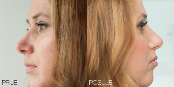 Dojmovi dobitnice 'Beauty makeovera' Poliklinike Bagatin: 'Sve bih ponovila'