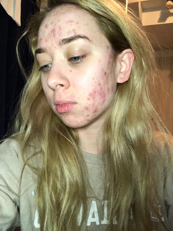 'Ne bih se trebala skrivati od akni'