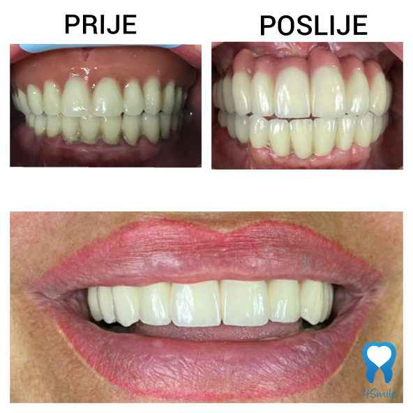 Što je kompletna oralna rehabilitacija?