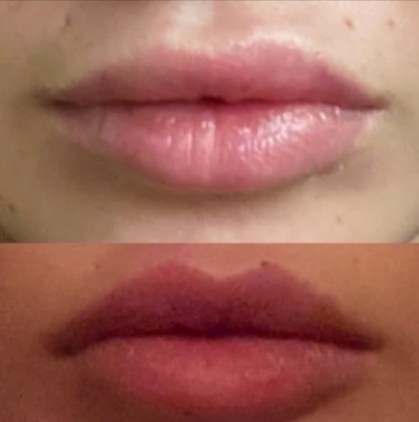 Povećanje usana Elle Dvornik