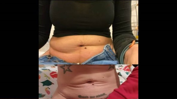 Coolsculpting Elle Dvornik