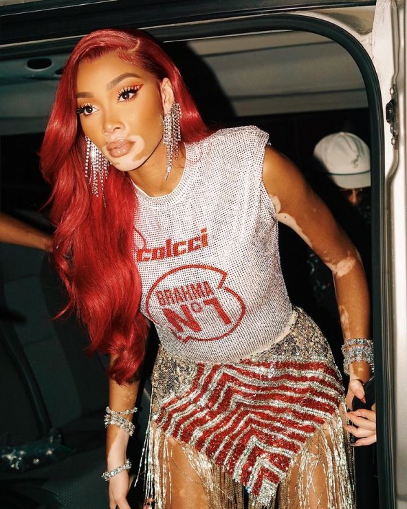 Manekenka Winnie Harlow boluje od vitiliga