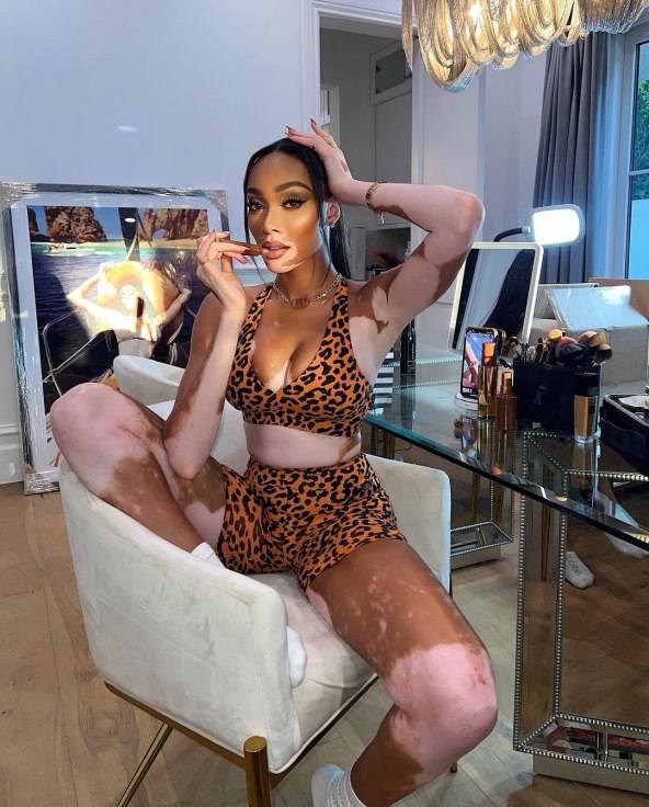Manekenka Winnie Harlow boluje od vitiliga