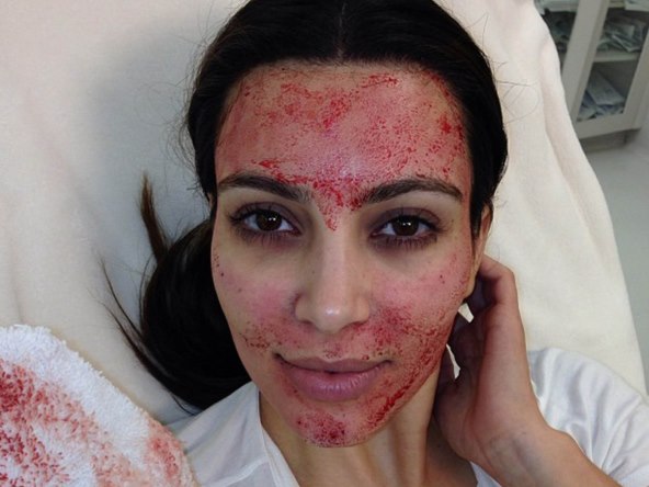 Kim Kardashian obožava PRP metodu pomlađivanja.