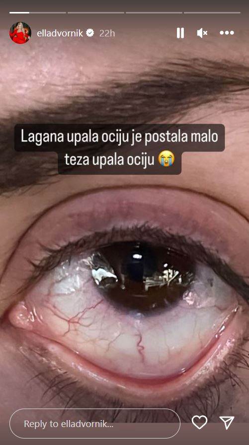 Ella Dvornik otkrila kako ima upalu očiju