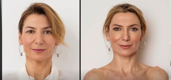 Daria Lorenzi Flatz bila je na blefaroplastici