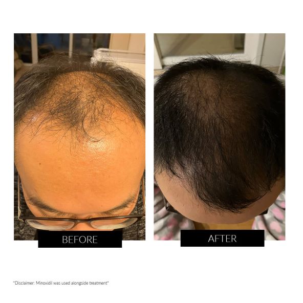 CurrentBody Skin LED Hair Regrowth Device (5).jpg