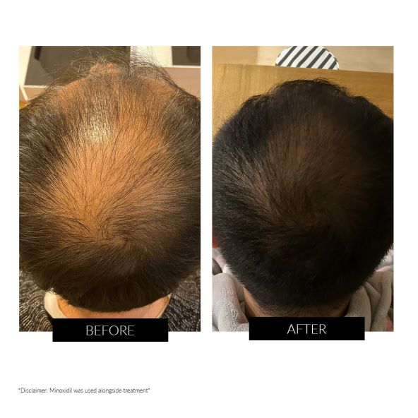 CurrentBody Skin LED Hair Regrowth Device (6).jpg
