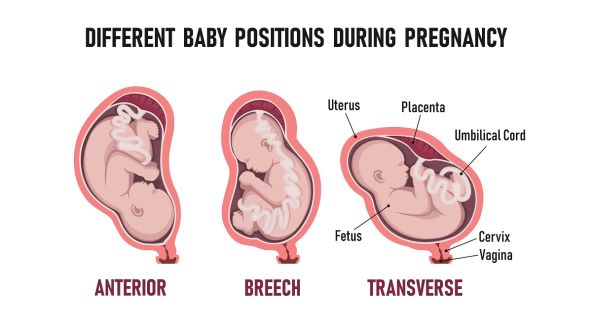 3 moguća položaja bebe u trbuhu i što napraviti za idealan položaj za porod