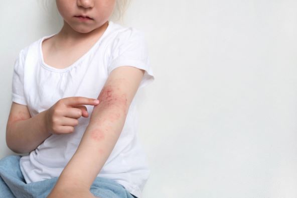atopijski dermatitis - simptomi i kako ga liječiti
