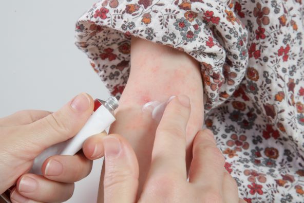 atopijski dermatitis - simptomi i kako ga liječiti