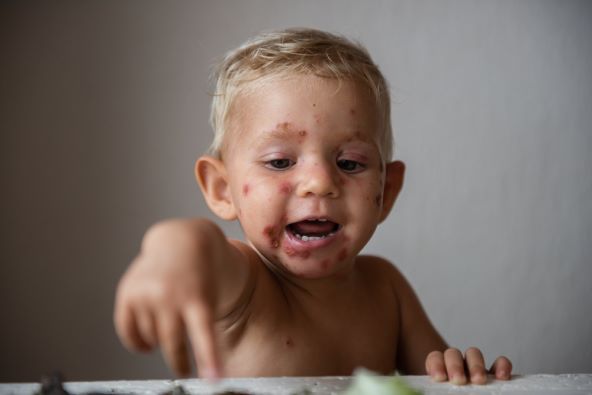 impetigo je visokozarazan