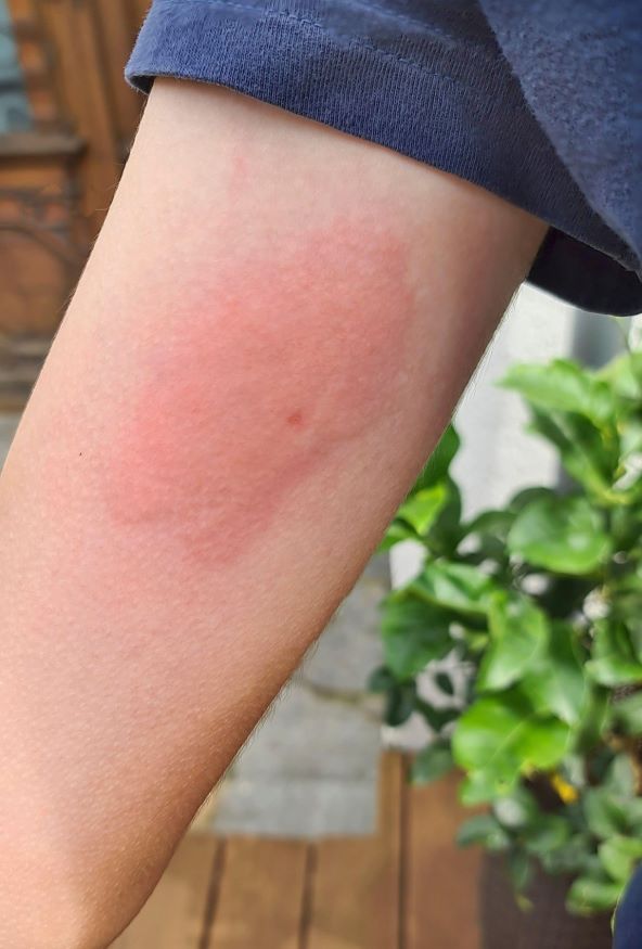 koji su simptomi anafilaktičkog šoka nakon uboda ose, pčele, stršljena