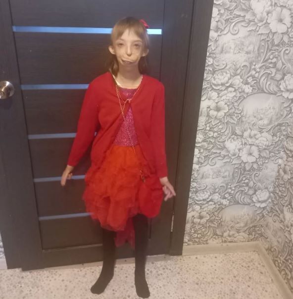 Kako danas izgleda djevojčica rođena bez pola lica?