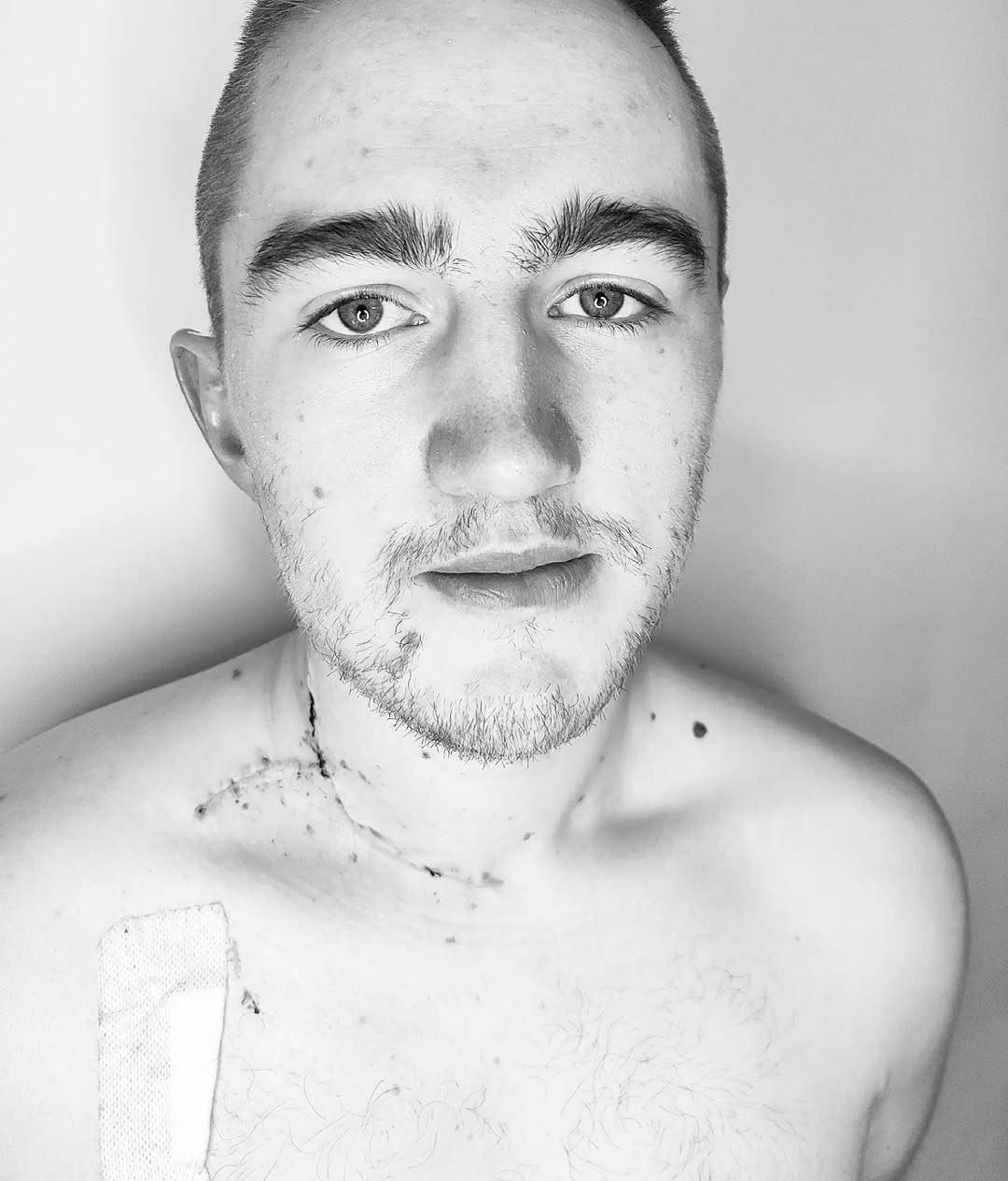 War wounds #3weeksout #melanomaawareness #melanomaisSHITE #surviving (1).jpg