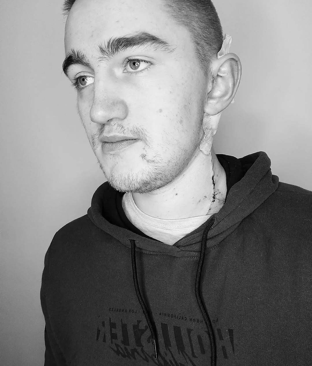 War wounds #3weeksout #melanomaawareness #melanomaisSHITE #surviving.jpg