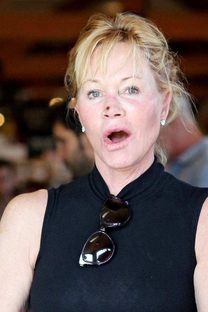 Melanie Griffith s ožiljkom na licu