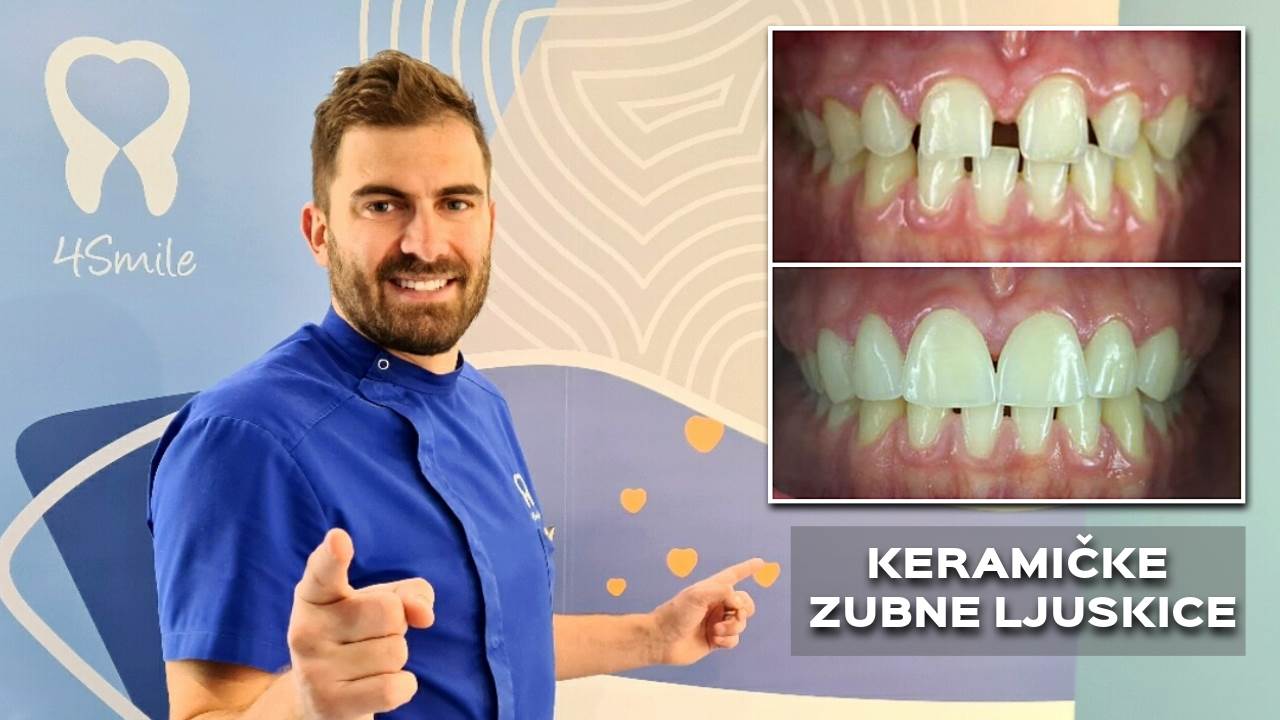 Razlika između kompozitnih i keramičkih zubnih ljuskica
