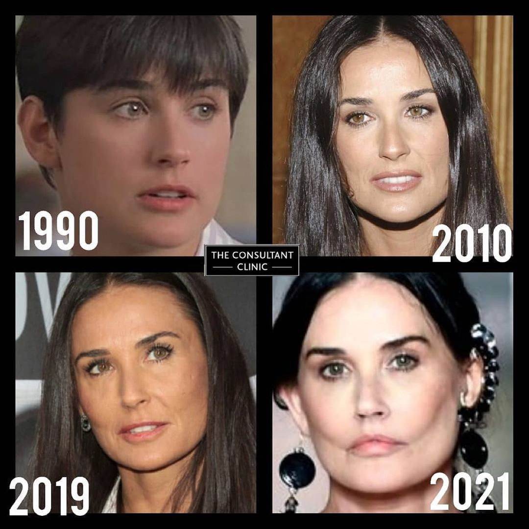 demi moore plastična operacija