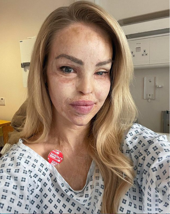 Katie Piper je bivši dečko zalio kiselinom