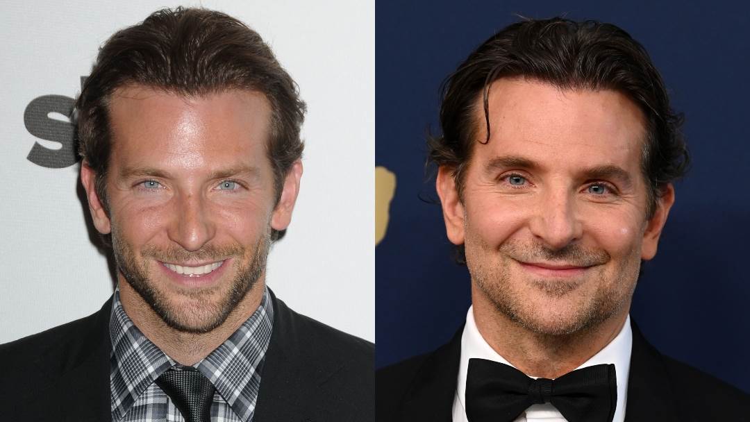 Bradley Cooper pobornik je estetskih tretmana i botoksa