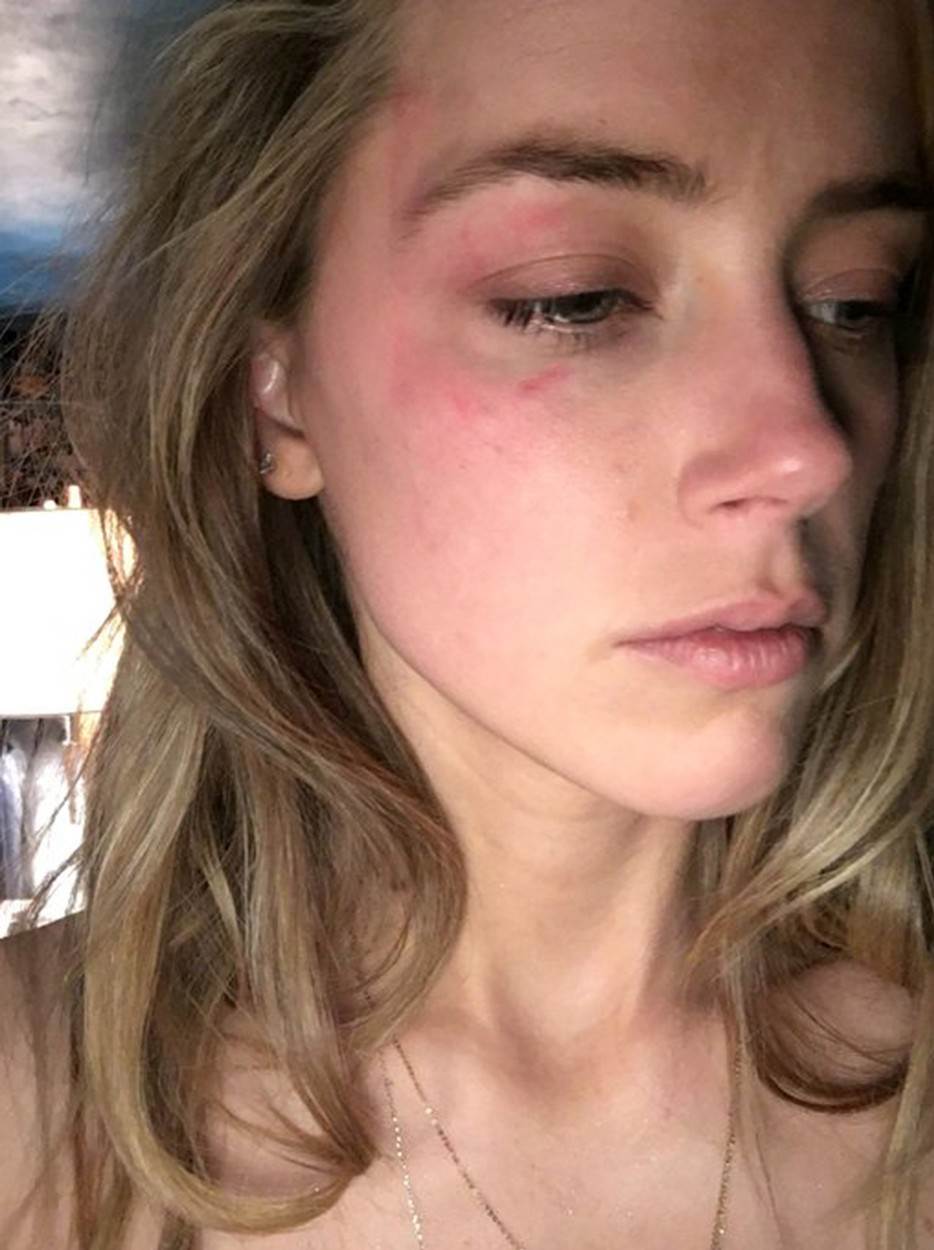 Amber Heard tvrdi da je Johnny Depp u braku bio nasilan