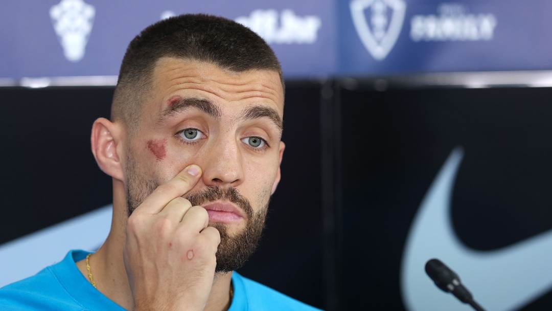 Mateo Kovačić ima masnicu na oku