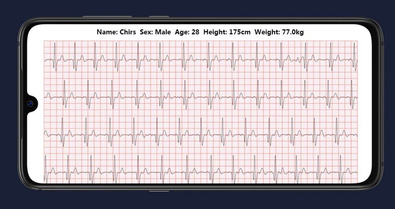 Dok se bavite sportom ova majica s EKG čipom prati otkucaje vašeg srca