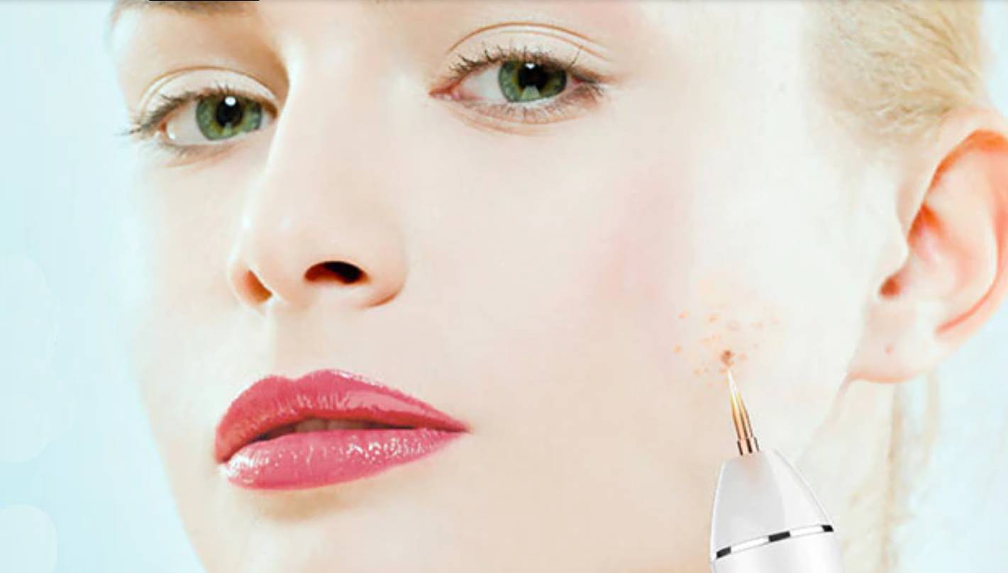 Laserska plazma olovka 3