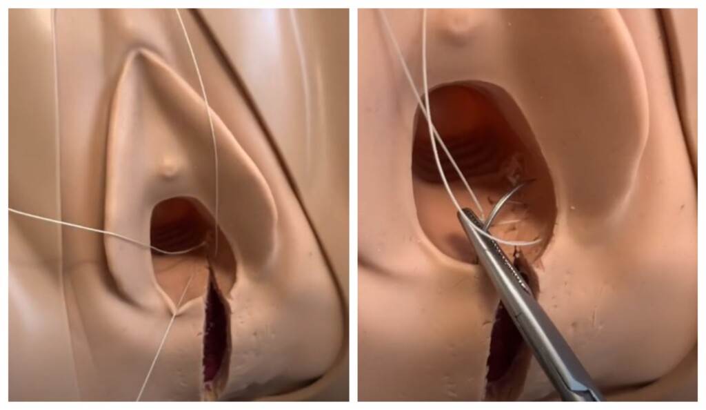 epiziotomija-za-mame-koje-zele-znati-vise-sto-vas-ocekuje-kod-sivanja-medice-i-kako-to-izgleda