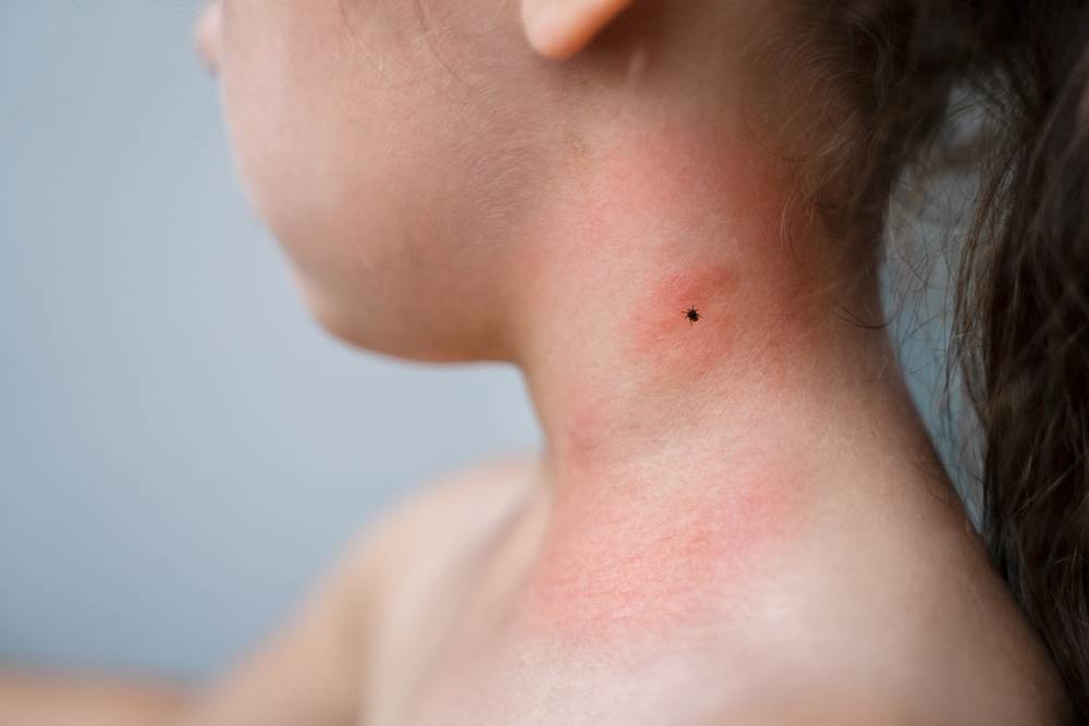 kako izvaditi krpelja i sprijeciti pojavu infekcije