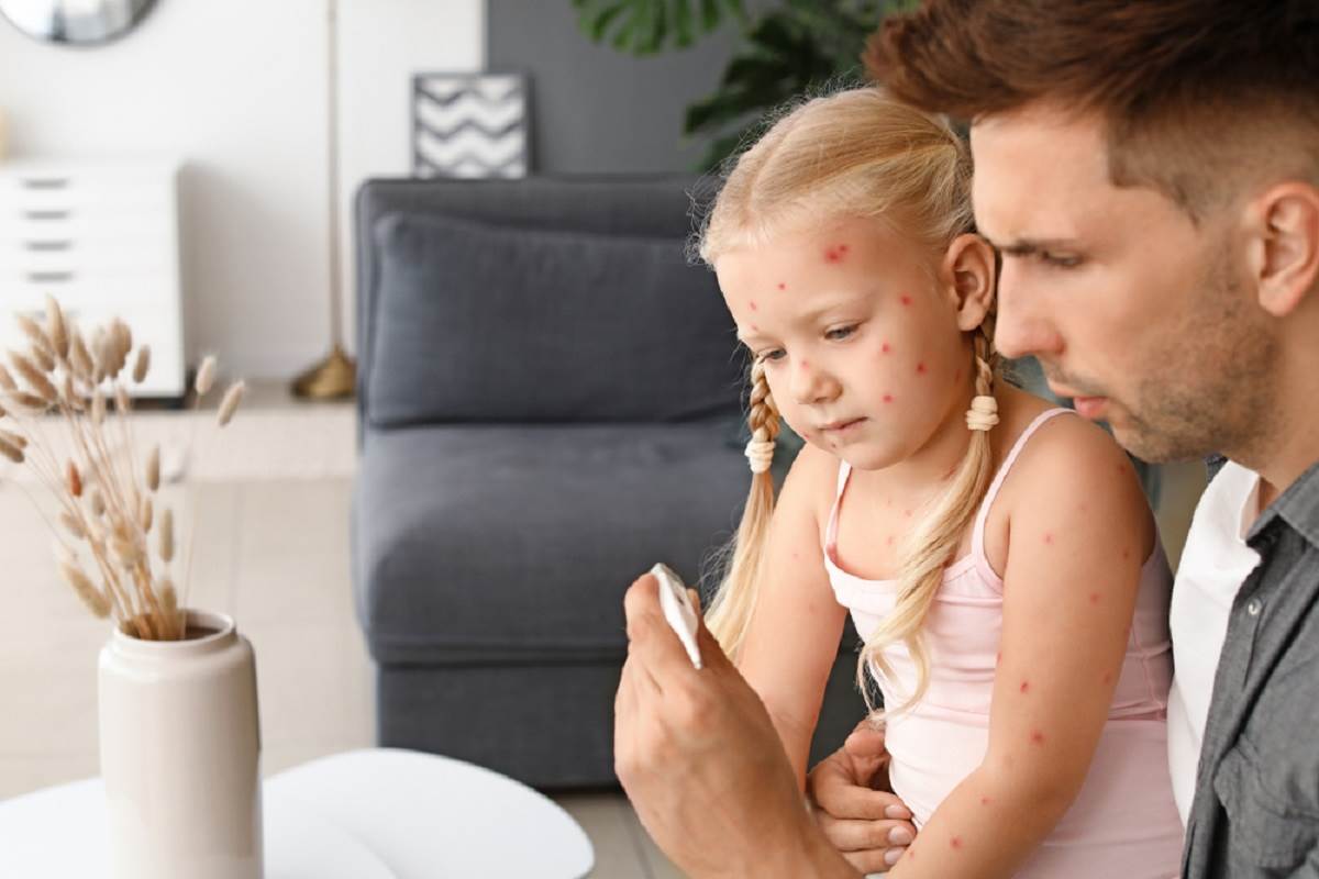 Pedijatar Jovancevic objašnjava je li moguce dva puta preboljeti vodene kozice