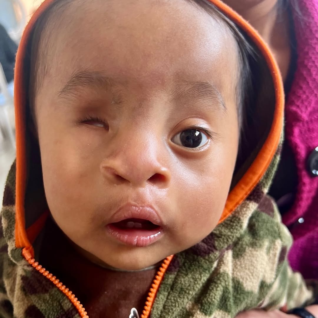 Kako sad izgleda djecak roden s rascjepom usne i nepca i bez oka? 