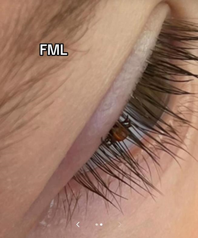 Bebi se krpelj zalijepio za trepavice